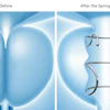 Before and after comparison of spring procedure showing anatomical structures with medical device placement