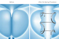 Before and after comparison of spring procedure showing anatomical structures with medical device placement