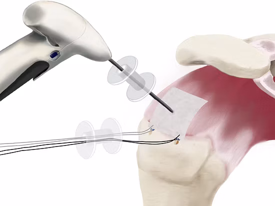 Arthroscopic knee surgery illustration showing surgical instruments and internal joint structures during minimally invasive procedure.