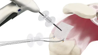 Arthroscopic knee surgery illustration showing surgical instruments and internal joint structures during minimally invasive procedure.