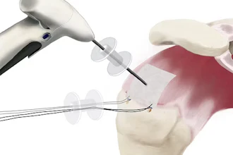 Arthroscopic knee surgery illustration showing surgical instruments and internal joint structures during minimally invasive procedure.