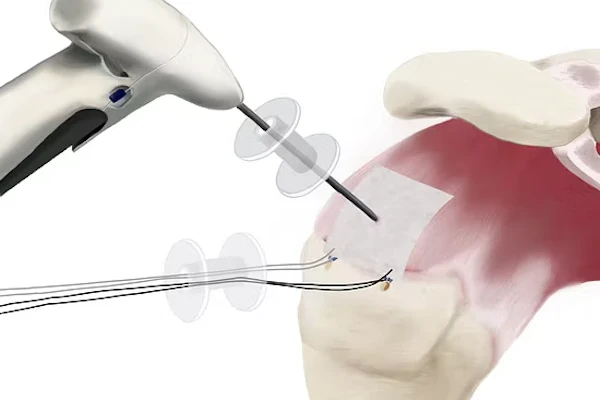 Arthroscopic knee surgery illustration showing surgical instruments and internal joint structures during minimally invasive procedure.